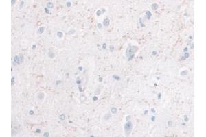 IHC-P analysis of Human Glioma Tissue, with DAB staining. (IL-10 抗体  (AA 1-178))