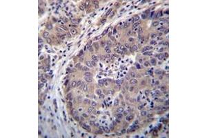Immunohistochemistry analysis in formalin fixed and paraffin embedded human hepatocarcinoma reacted with PNLIPRP3 Antibody (N-term) followed which was peroxidase conjugated to the secondary antibody and followed byDAB staining. (PNLIPRP3 抗体  (N-Term))