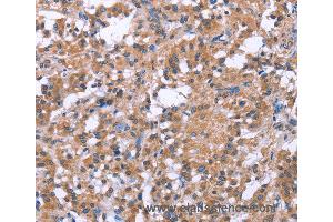 Immunohistochemistry of Human gastric cancer using SLC52A1 Polyclonal Antibody at dilution of 1:40 (GPR172B 抗体)