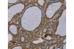 Immunohistochemistry of Human esophagus cancer using S100A6 Polyclonal Antibody at dilution of 1:35 (S100A6 抗体)