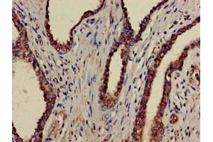 Immunohistochemistry of paraffin-embedded human prostate cancer using ABIN7145034 at dilution of 1:100 (ATAD1 抗体  (AA 289-350))