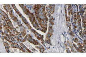 ABIN6267165 at 1/100 staining Human thyroid cancer tissue by IHC-P.