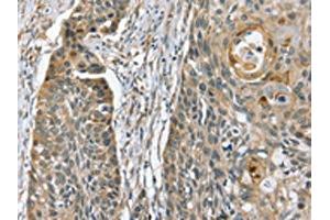 The image on the left is immunohistochemistry of paraffin-embedded Human esophagus cancer tissue using ABIN7130610(PHLPP1 Antibody) at dilution 1/35, on the right is treated with fusion protein. (PHLPP1 抗体)
