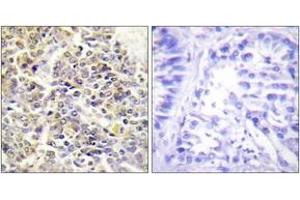 Immunohistochemistry analysis of paraffin-embedded human lung carcinoma tissue, using ASC Antibody. (STS 抗体  (AA 10-59))