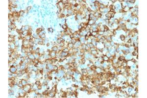 Formalin-fixed, paraffin-embedded human Melanoma stained with gp100 Mouse Monoclonal Antibody (PMEL/2039). (Melanoma gp100 抗体  (AA 376-502))