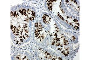 IHC-P: p107 antibody testing of human intestinal cancer tissue (p107 抗体  (C-Term))