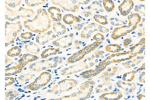ABIN6265577 and ABIN6273331 at 1/100 staining Human kidney cancer and adjacent normal tissues by IHC-P. (TIMM9 抗体  (C-Term))