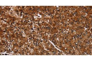Immunohistochemistry of paraffin-embedded Human prostate cancer using ACP6 Polyclonal Antibody at dilution of 1:30 (ACP6 抗体)