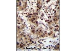 ZN Antibody (N-term) (ABIN655359 and ABIN2844918) immunohistochemistry analysis in formalin fixed and paraffin embedded human breast carcinoma followed by peroxidase conjugation of the secondary antibody and DAB staining. (ZNF321P 抗体  (N-Term))