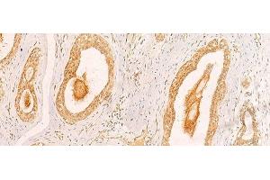 Immunohistochemistry of paraffin-embedded Human breast cancer tissue using ZNF580 Polyclonal Antibody at dilution of 1:40(x200) (ZNF580 抗体)