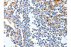 The image on the left is immunohistochemistry of paraffin-embedded Human tonsil tissue using ABIN7191316(LRP1 Antibody) at dilution 1/90, on the right is treated with synthetic peptide. (LRP1 抗体)