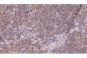 ABIN6273189 at 1/100 staining Human lymph cancer tissue by IHC-P. (ACAA1 抗体  (N-Term))
