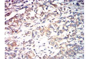 Immunohistochemical analysis of paraffin-embedded bladder cancer tissues using CALR mouse mAb with DAB staining. (Calreticulin 抗体  (AA 18-417))