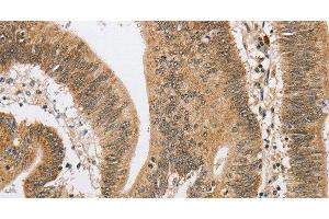 Immunohistochemistry of paraffin-embedded Human colon cancer using ARHGAP25 Polyclonal Antibody at dilution of 1:40 (ARHGAP25 抗体)