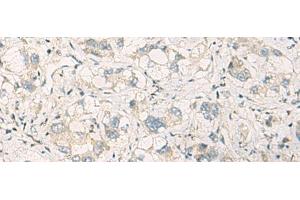 Immunohistochemistry of paraffin-embedded Human liver cancer tissue using SPSB2 Polyclonal Antibody at dilution of 1:70(x200) (SPSB2 抗体)