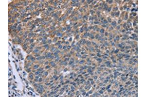 The image on the left is immunohistochemistry of paraffin-embedded Human lung cancer tissue using ABIN7129622(GNAI3 Antibody) at dilution 1/30, on the right is treated with fusion protein. (GNAI3 抗体)