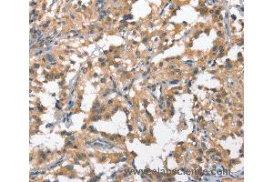 Immunohistochemistry of Human breast cancer using HGF Polyclonal Antibody at dilution of 1:65 (HGF 抗体)