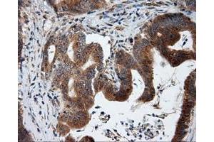 Immunohistochemical staining of paraffin-embedded liver tissue using anti-KIAA1609 mouse monoclonal antibody. (KIAA1609 抗体)
