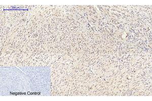 Immunohistochemical analysis of paraffin-embedded human uterus cancer tissue. (Connexin 43/GJA1 抗体  (AA 310-390))