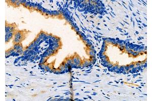 ABIN6260857 and ABIN6266905 at 1/100 staining Human prostate cancer by IHC-P. (CKS2 抗体  (Internal Region))