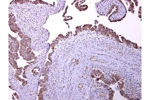 IHC-P Image GABA B Receptor 1 antibody [N2C1], Internal detects GABA B Receptor 1 protein at cytosol on human ovarian carcinoma by immunohistochemical analysis. (GABBR1 抗体)