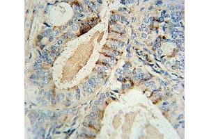 GCNT2 antibody immunohistochemistry analysis in formalin fixed and paraffin embedded human prostate carcinoma.