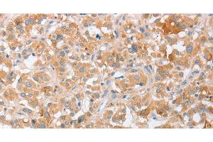 Immunohistochemistry of paraffin-embedded Human thyroid cancer tissue using SIGLEC9 Polyclonal Antibody at dilution 1:40 (SIGLEC9 抗体)