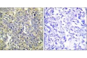 Immunohistochemistry analysis of paraffin-embedded human lung carcinoma, using Caspase 9 (Phospho-Thr125) Antibody. (Caspase 9 抗体  (pThr125))