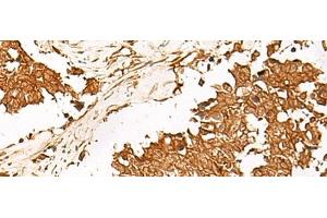 Immunohistochemistry of paraffin-embedded Human lung cancer tissue using HUS1 Polyclonal Antibody at dilution of 1:65(x200) (HUS1 抗体)