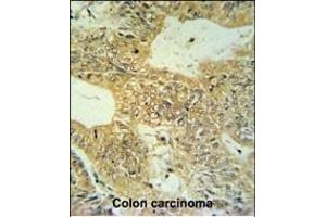 CLDN23 Antibody (C-term) (ABIN653789 and ABIN2843074) IHC analysis in formalin fixed and paraffin embedded colon carcinoma followed by peroxidase conjugation of the secondary antibody and DAB staining. (Claudin 23 抗体  (C-Term))