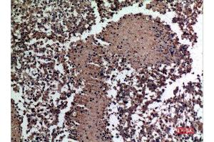 Immunohistochemistry (IHC) analysis of paraffin-embedded Human Lung Cancer, antibody was diluted at 1:100.
