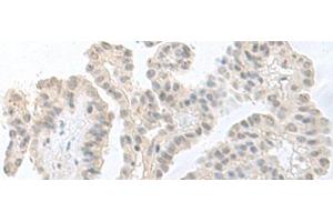 Immunohistochemistry of paraffin-embedded Human thyroid cancer tissue using RPS27L Polyclonal Antibody at dilution of 1:55(x200) (RPS27L 抗体)