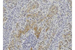 ABIN6276395 at 1/100 staining Human lung cancer tissue by IHC-P. (Endothelin 1 抗体  (C-Term))