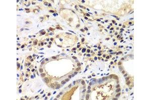 Immunohistochemistry of paraffin-embedded Human gastric cancer using PSME2 Polyclonal Antibody at dilution of 1:100 (40x lens). (PSME2 抗体)