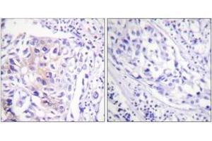 Immunohistochemistry analysis of paraffin-embedded human breast carcinoma, using CBL (Phospho-Tyr774) Antibody. (CBL 抗体  (pTyr774))