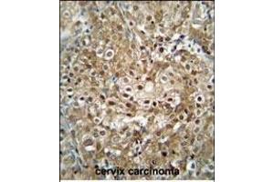C antibody (C-term) (ABIN654740 and ABIN2844426) immunohistochemistry analysis in formalin fixed and paraffin embedded human cervix carcinoma followed by peroxidase conjugation of the secondary antibody and DAB staining. (CF153 (AA 230-259), (C-Term) 抗体)
