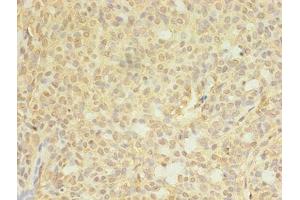 Immunohistochemistry of paraffin-embedded human breast cancer using ABIN7148714 at dilution of 1:100 (CTP Synthase 抗体  (AA 300-554))