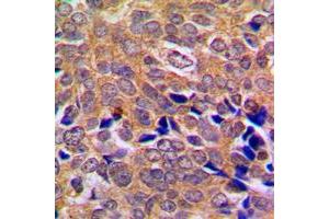 Immunohistochemical analysis of ABL1/2 staining in human breast cancer formalin fixed paraffin embedded tissue section. (ABL1/2 抗体  (C-Term))