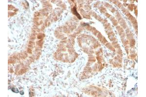 Formalin-fixed, paraffin-embedded human colon carcinoma stained with AKT1 Recombinant Mouse Monoclonal Antibody (rAKT1/2491). (Recombinant AKT1 抗体  (AA 85-189))