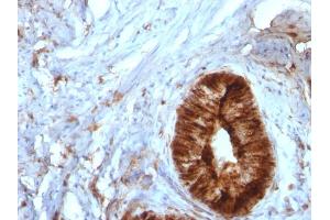 Formalin-fixed, paraffin-embedded human Cervical Carcinoma stained with Beta-2-Microglobulin Mouse Monoclonal Antibody (B/961). (beta-2 Microglobulin 抗体)