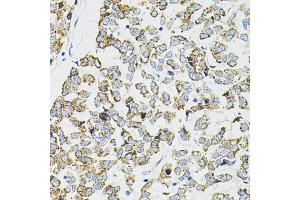 Immunohistochemistry of paraffin-embedded human esophageal cancer using PPP1CA antibody (ABIN6290760) at dilution of 1:100 (40x lens). (PPP1CA 抗体)