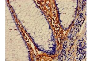 Immunohistochemistry of paraffin-embedded human colon cancer using ABIN7160053 at dilution of 1:100 (MAP3K7 抗体  (AA 101-400))