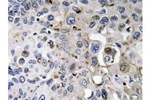 Immunohistochemistry analyzes of PDGF-A antibody in paraffin-embedded human lung carcinoma tissue. (PDGFA 抗体)