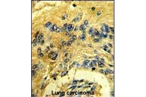 Formalin-fixed and paraffin-embedded human lung carcinoma reacted with CDK3 Antibody (N-term Y19), which was peroxidase-conjugated to the secondary antibody, followed by DAB staining. (CDK3 抗体  (N-Term))