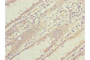 Immunohistochemistry of paraffin-embedded human colon cancer using ABIN7149316 at dilution of 1:100 (DYNC1I1 抗体  (AA 1-220))