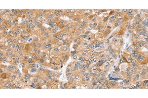 Immunohistochemistry of paraffin-embedded Human liver cancer using ZFP36L2 Polyclonal Antibody at dilution of 1:45 (ZFP36L2 抗体)