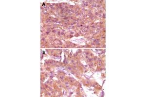 Immunohistochemical analysis of paraffin-embedded human skin carcinoma (A) and breast carcinoma (B), showing cytoplasmic and membrane localization using SRA1 monoclonal antibody, clone 1D4H8  with DAB staining. (SRA1 抗体)