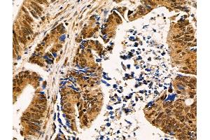 ABIN6258686 and ABIN6274922 at 1/100 staining Human colorectal cancer by IHC-P. (FAM203B 抗体  (Internal Region))