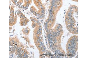 Immunohistochemistry of Human breast cancer using PARD6A Polyclonal Antibody at dilution of 1:60 (PARD6A 抗体)