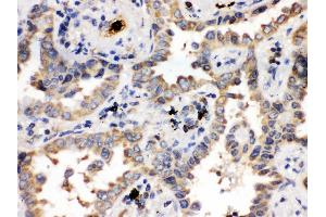 Anti- ULK3 Picoband antibody, IHC(P) IHC(P): Human Lung Cancer Tissue (ULK3 抗体  (C-Term))